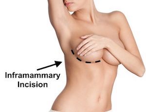 inframammary incision location
