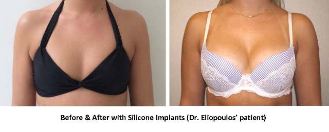 Silicone Gel Breast Implants in Boston, MA