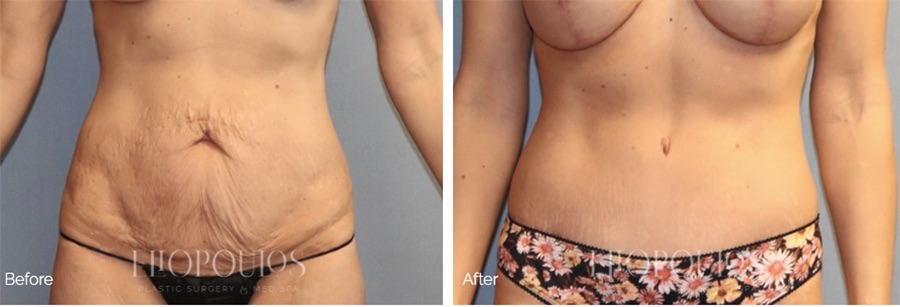 Skin Removal Surgery After Significant Weight Loss in the Era of Semaglutide Injections