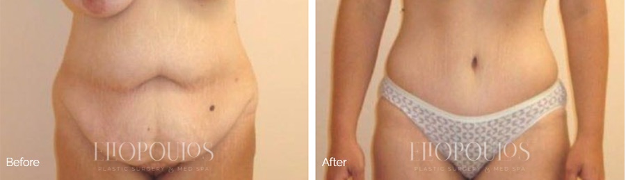 Skin Removal Surgery After Significant Weight Loss in the Era of Semaglutide Injections