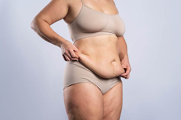 Skin Removal Surgery After Significant Weight Loss in the Era of Semaglutide Injections