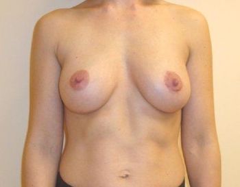 Breast Revision & Asymmetry Before And After