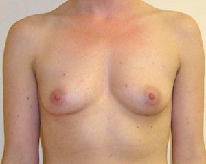 Breast Augmentation Boston