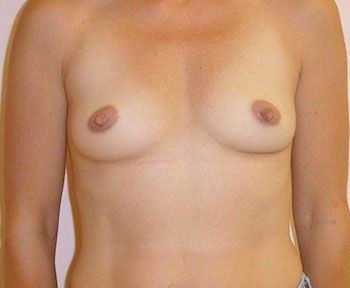 Breast Implants Before And After