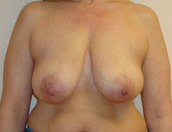 Breast Lift Boston