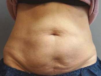 CoolSculpting Before And After