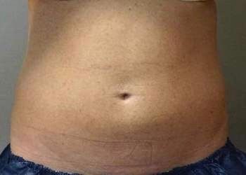 CoolSculpting For Men Before And After