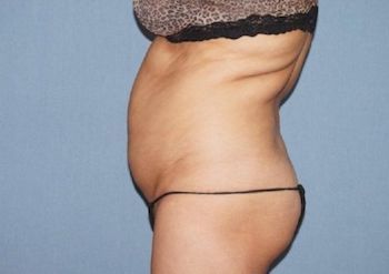 Liposuction Boston