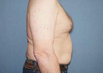 Gynecomastia Surgery Before And After