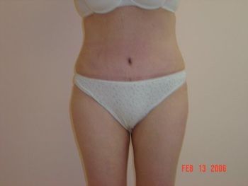 Tummy Tuck Before And After