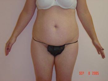 Tummy Tuck Before And After