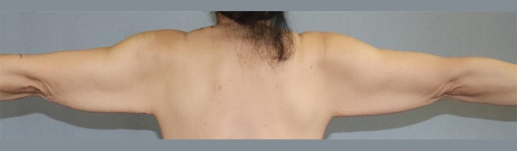 Arm Lift Before & After Image