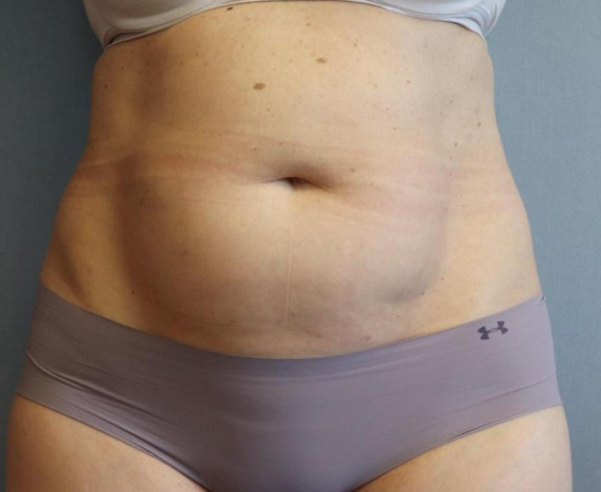 CoolSculpting Before & After Image