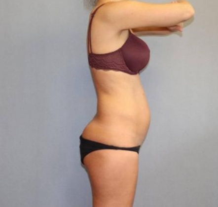 Liposuction Before & After Image