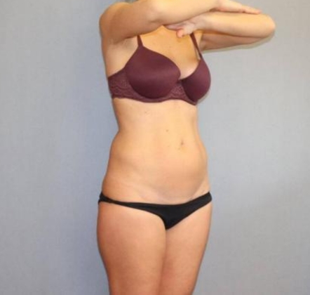 Liposuction Before & After Image