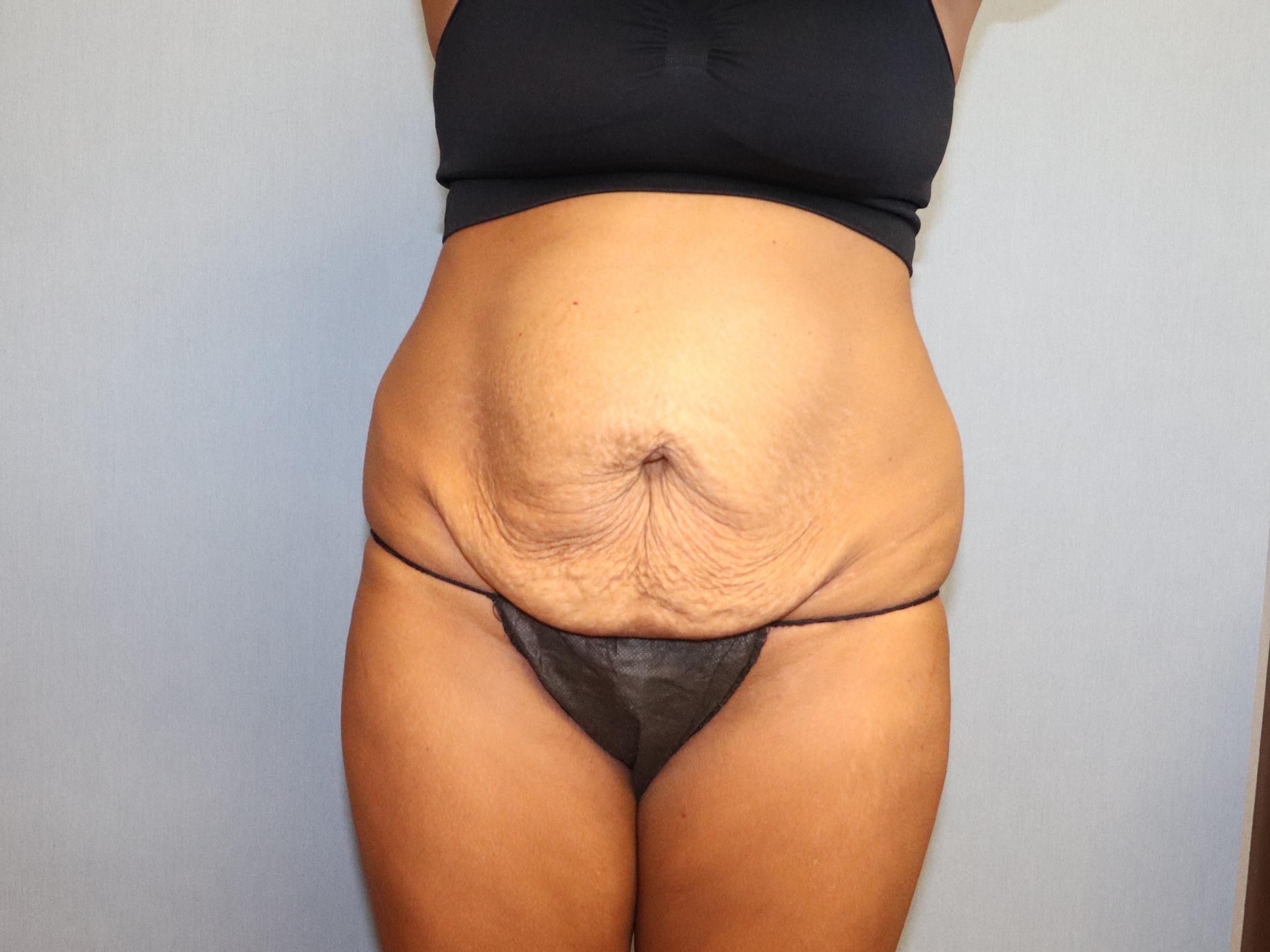 Tummy Tuck Before & After Image