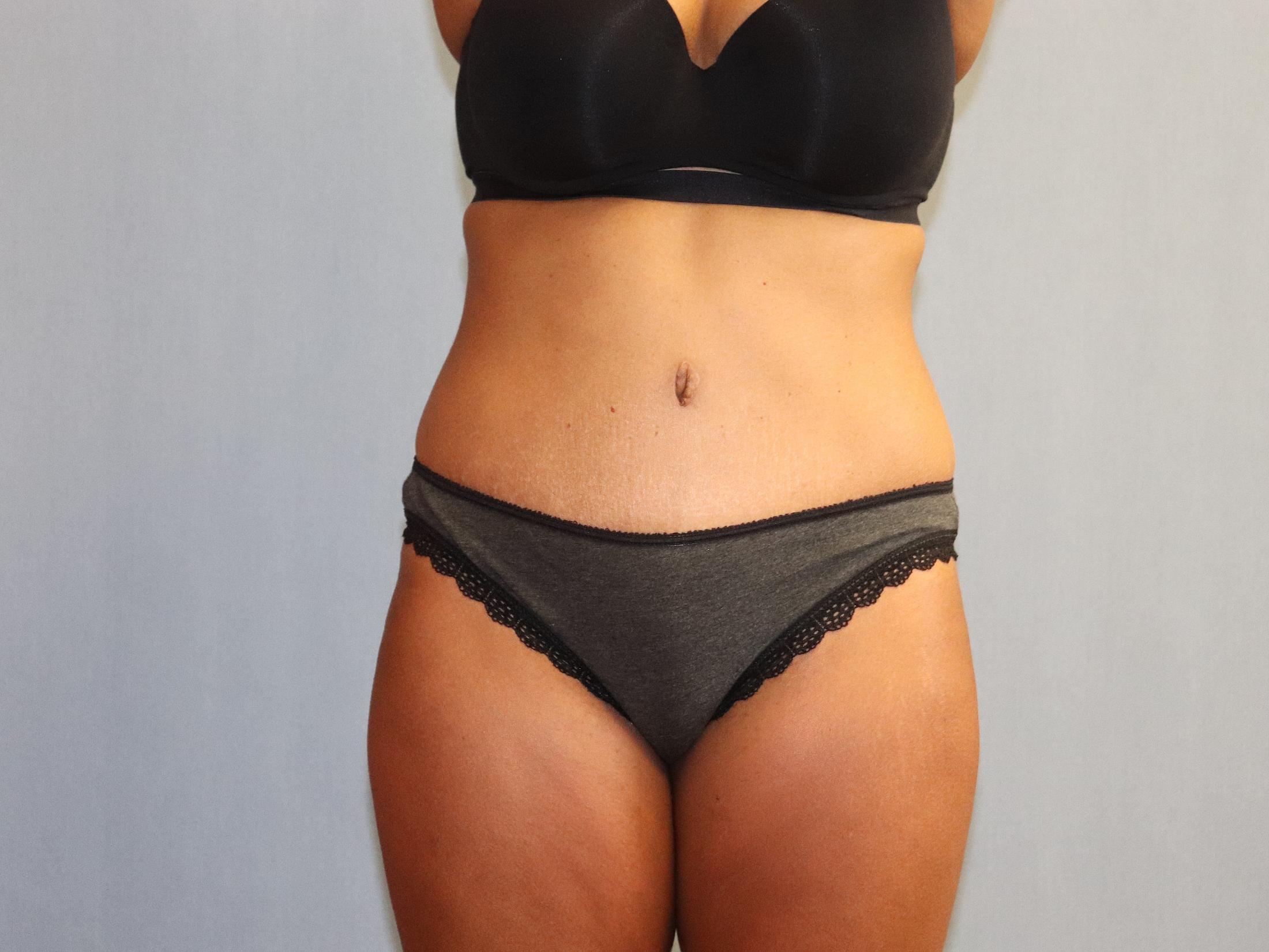 Tummy Tuck Before & After Image