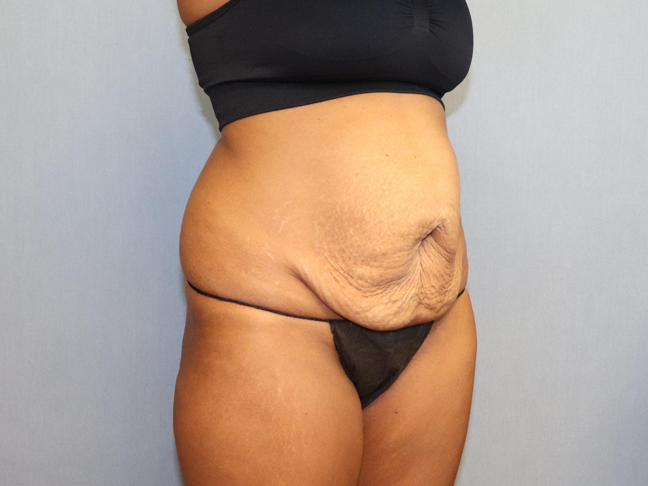 Tummy Tuck Before & After Image