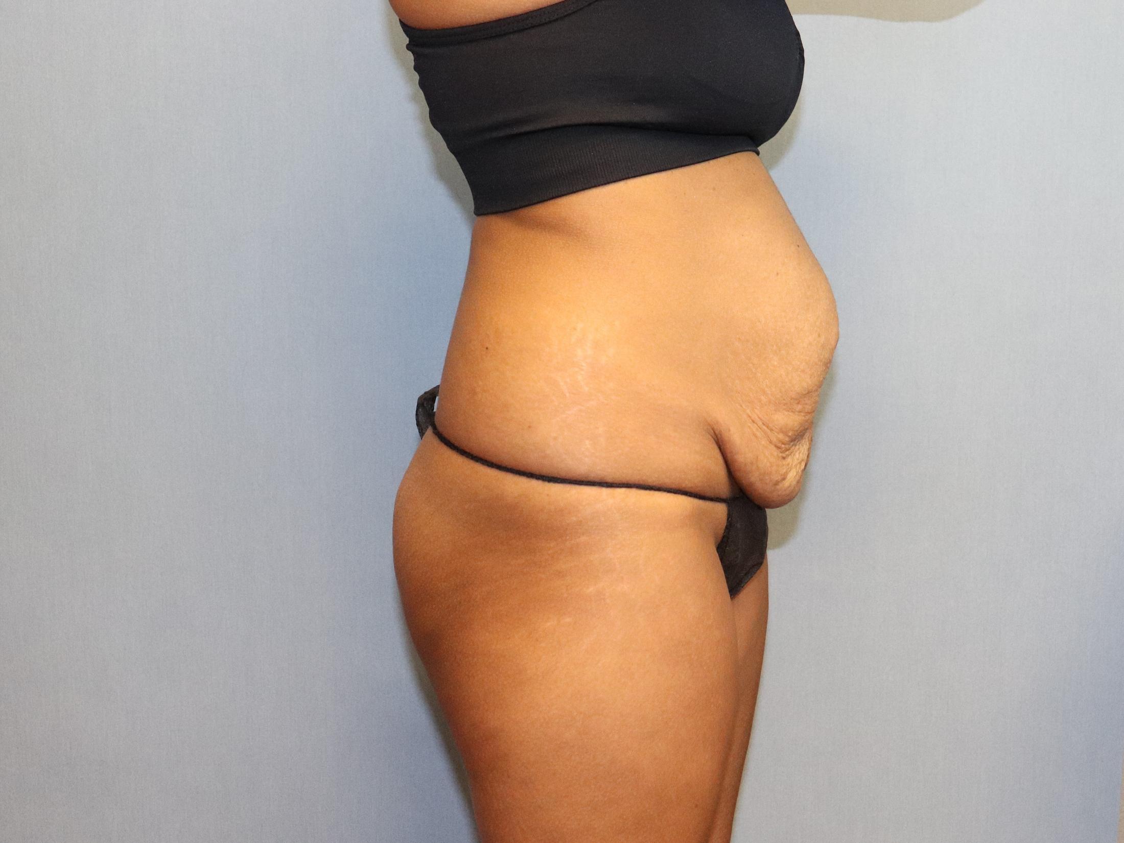 Tummy Tuck Before & After Image