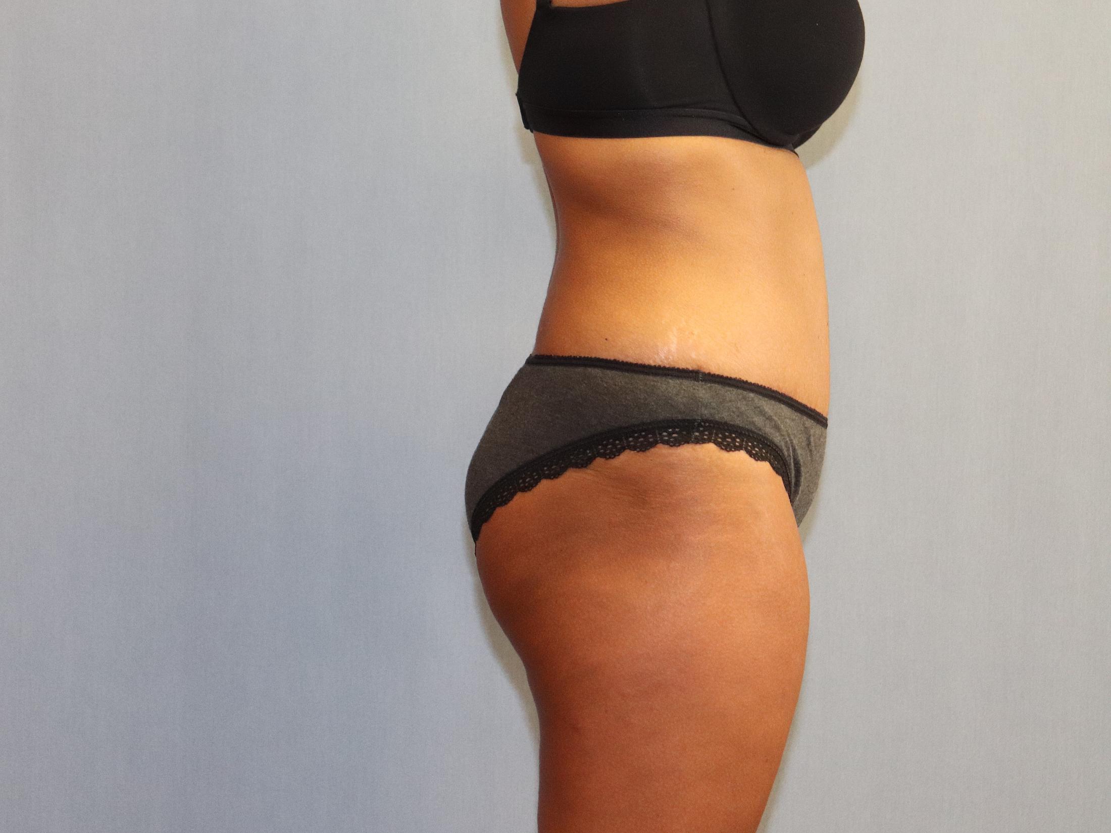 Tummy Tuck Before & After Image