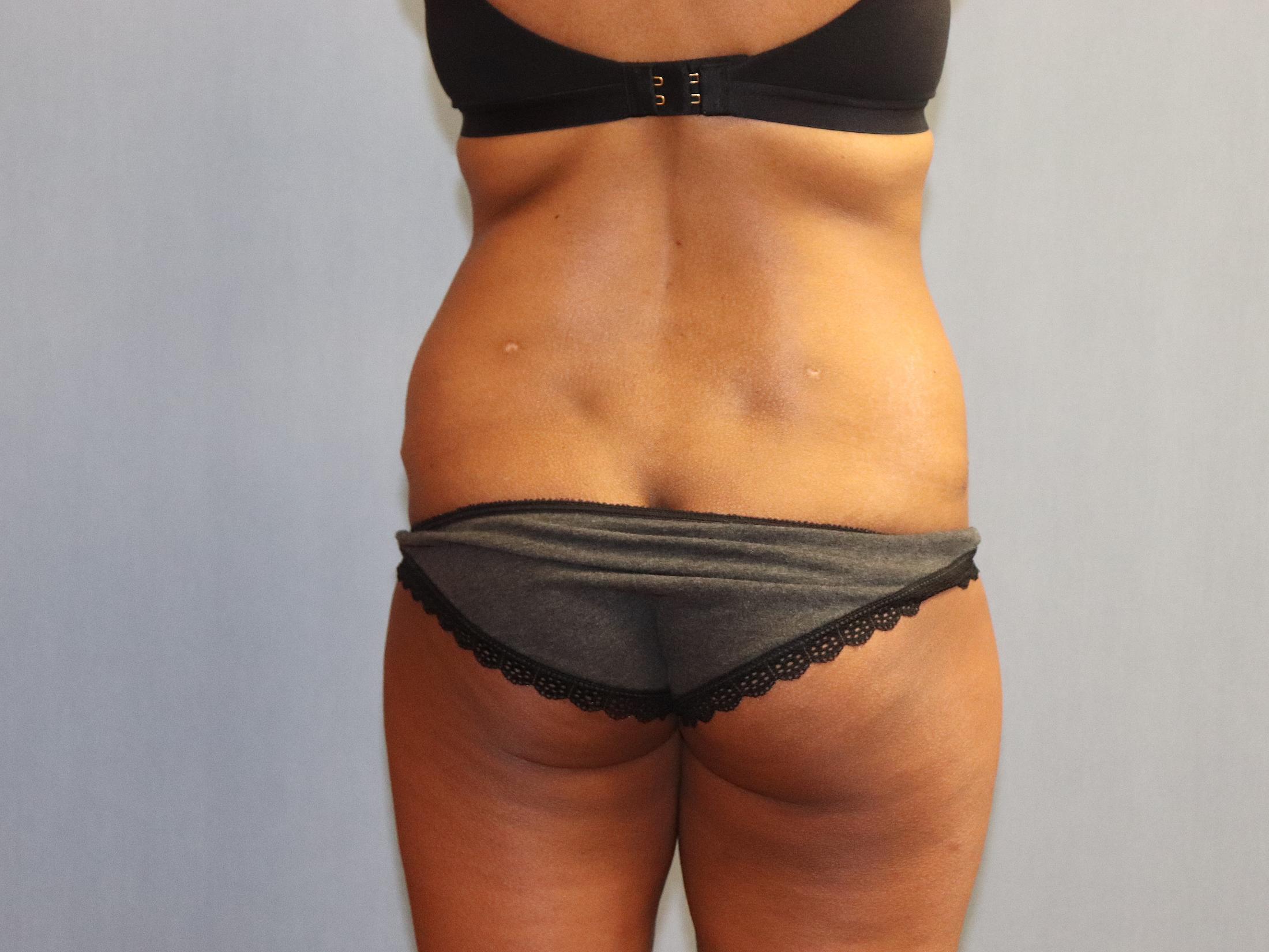 Tummy Tuck Before & After Image