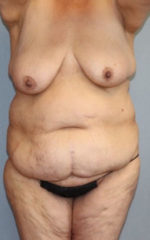 Tummy Tuck Before & After Image