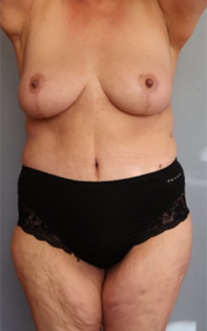 Tummy Tuck Before & After Image