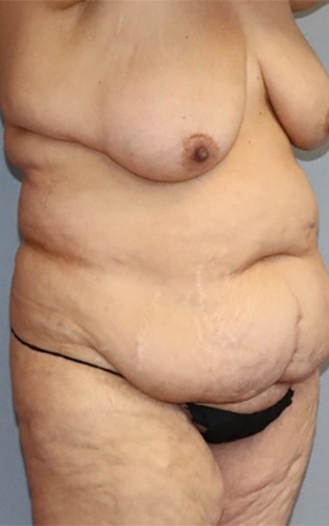 Tummy Tuck Before & After Image