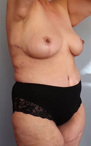 Tummy Tuck Before & After Image