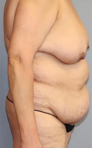 Tummy Tuck Before & After Image