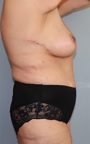 Tummy Tuck Before & After Image