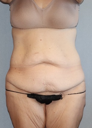 Tummy Tuck Before & After Image