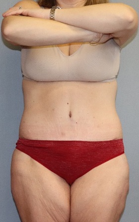 Tummy Tuck Before & After Image