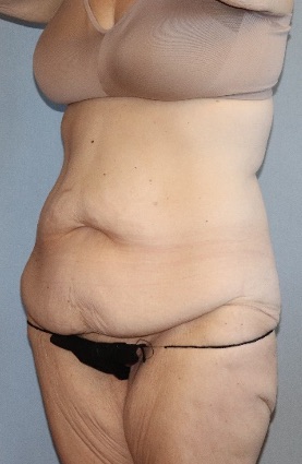 Tummy Tuck Before & After Image