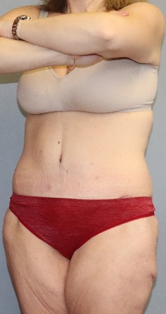 Tummy Tuck Before & After Image