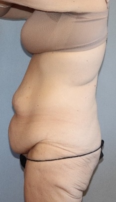 Tummy Tuck Before & After Image