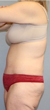 Tummy Tuck Before & After Image