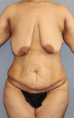 Tummy Tuck Before & After Image