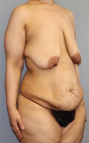 Tummy Tuck Before & After Image