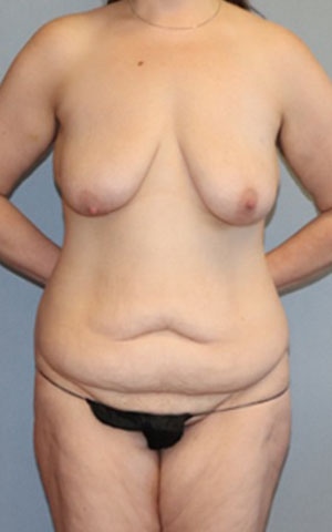 Tummy Tuck Before & After Image