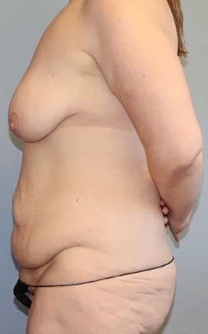 Tummy Tuck Before & After Image