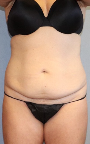 Tummy Tuck Before & After Image