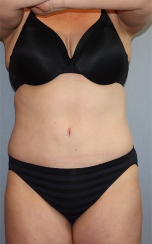 Tummy Tuck Before & After Image