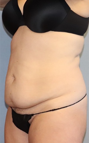 Tummy Tuck Before & After Image