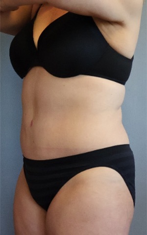 Tummy Tuck Before & After Image