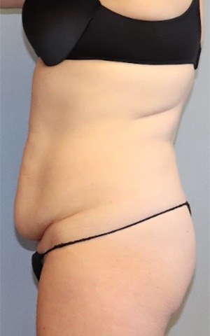 Tummy Tuck Before & After Image