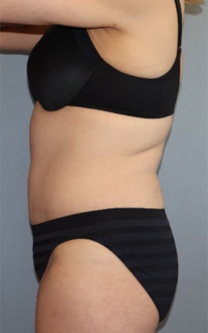 Tummy Tuck Before & After Image