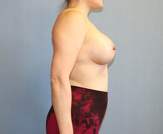 Breast Augmentation Before & After Image