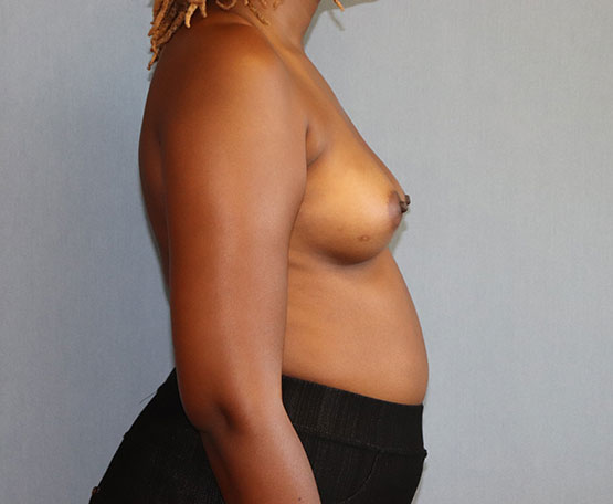 Breast Augmentation Before & After Image