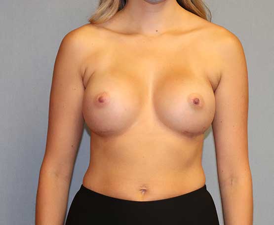 Breast Augmentation Before & After Image